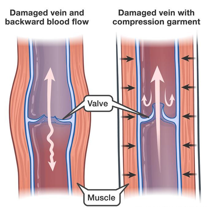 How Compression Helps Veins