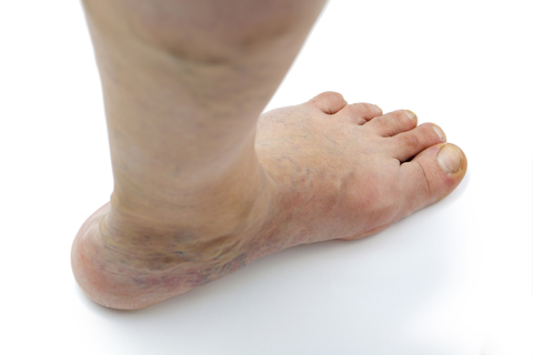 Varicose Veins Ankle Skin