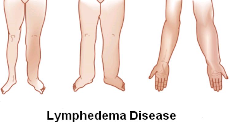 What is Lymphoedema
