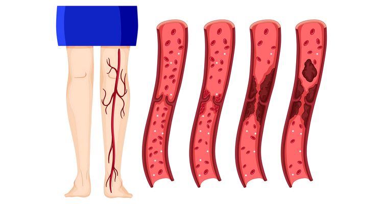 DVT Not Just Confined to Long-Haul