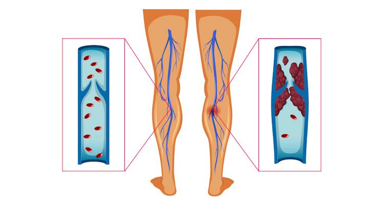 Risk and Prevention of Blood Clots