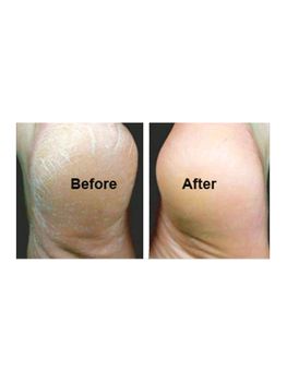 Ureka Foot Care Pack (Heels Before and After)