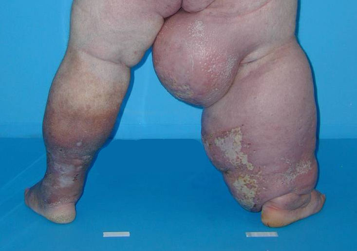 Elephantiasis