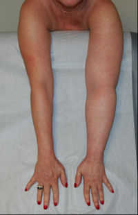 Lymph Arms