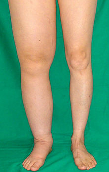 Lymph Legs