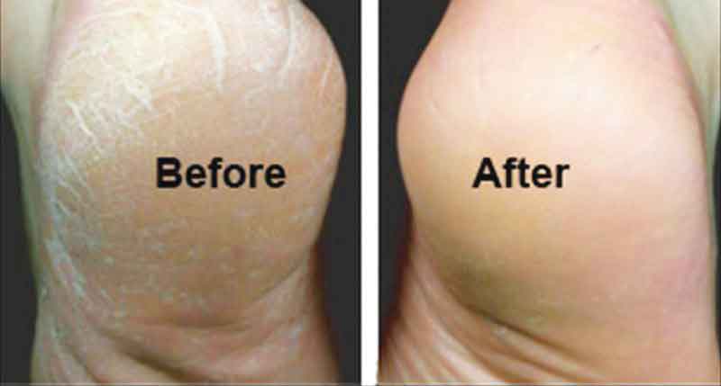 Heels Before and After