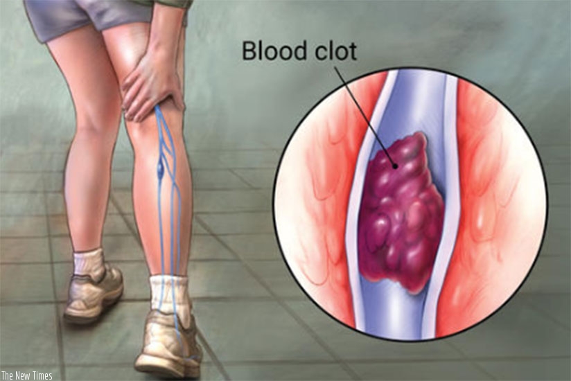 DVT in Leg Vein Illustration